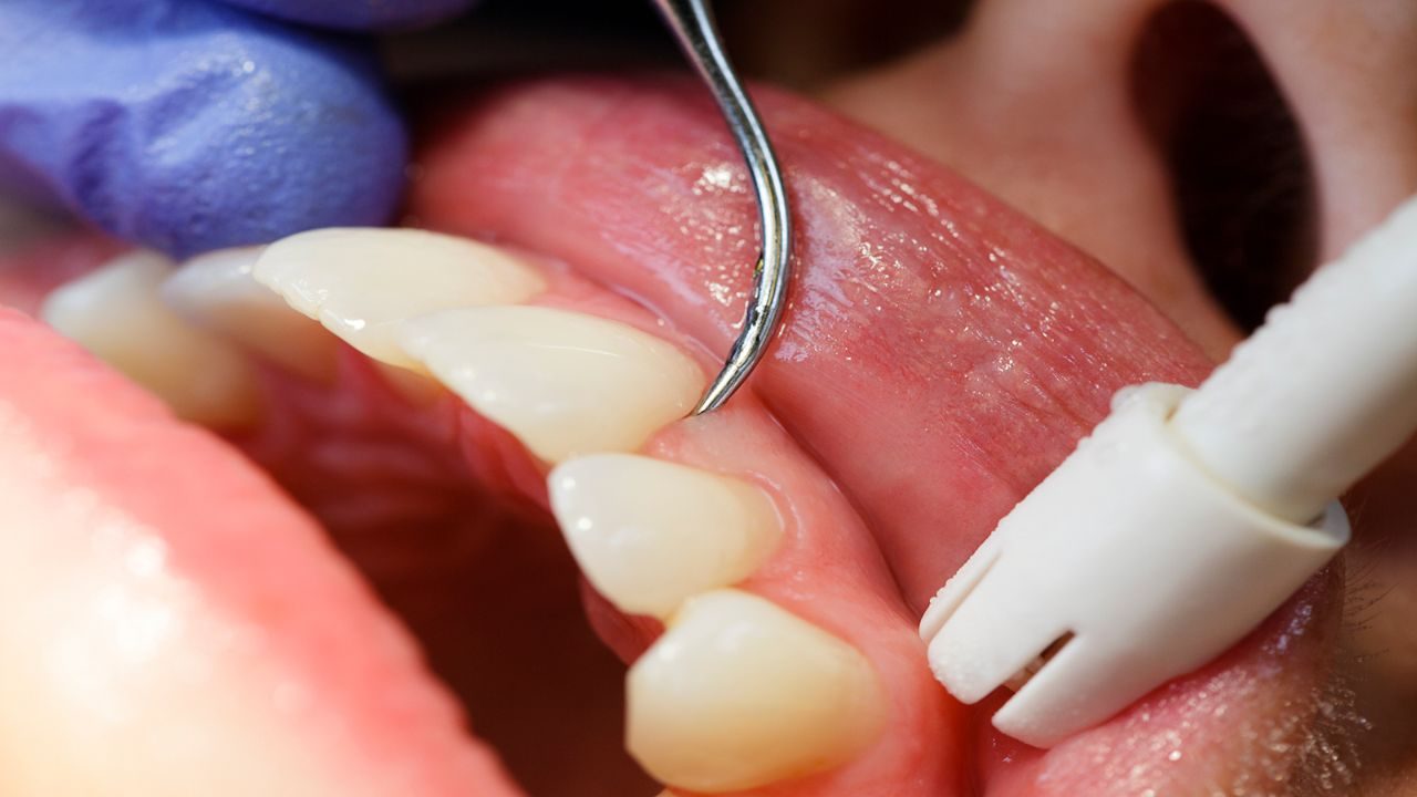 Caring for Implants and Keeping Gums Healthy